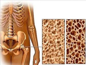 Meme Kanseri Geçirmiş Olanların Osteoporoz Hakkında Bilmeleri Gerekenler