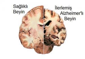 Beyin Sağlığı ve Bilişsel Gerileme