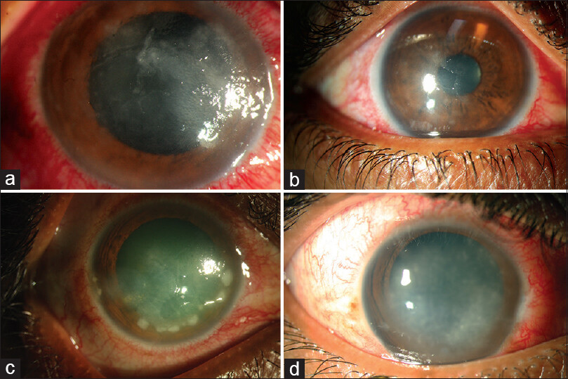 Acanthamoeba: Göz Enfeksiyonu ve Keratit