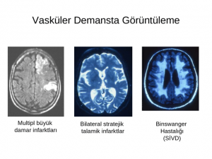 Vasküler Demans Nedir?