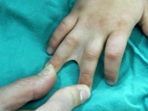 Sindaktili Hastalığı Nedir? Teşhis ve Tedavi Yöntemleri