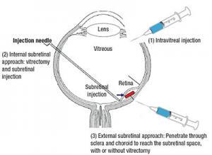 Retinal Hastalıklar İçin Kök Hücre Uygulamaları