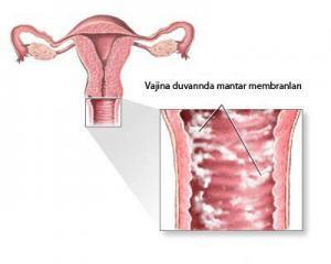 Candida Albicans'ın Sebep Olduğu Hastalıklar