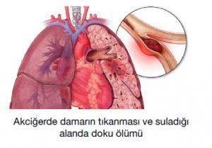 Derin Ven Trombozu (DVT) Nedir?