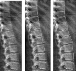 DEXA Taraması Nedir?