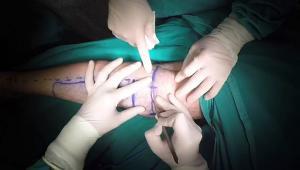Baldır İmplantları Nedir? Nasıl Yapılır?