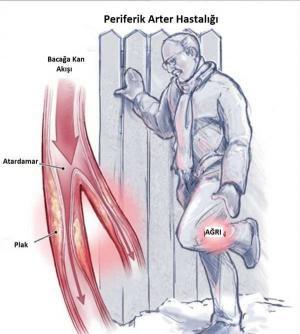 Periferik Arter Hastalığı Nedir?
