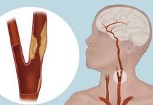 Periferik Arter Hastalığı Nedir?