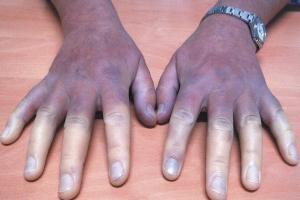 Periferik Arter Hastalığı Nedir?