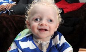 Angelman Sendromu Nedir?
