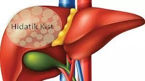 Karaciğer Kisti ve Tedavisi