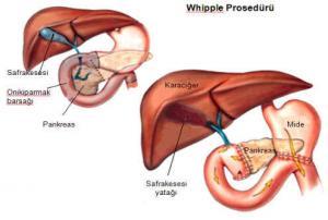 Whipple Hastalığı ve Tedavisi