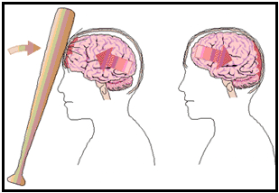 Beynin Frontal Lobunun Yapısı, Fonksiyonları ve Hasarları