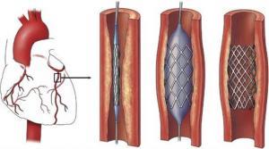 Stent Nedir? Hangi Durumlarda Kullanılır?