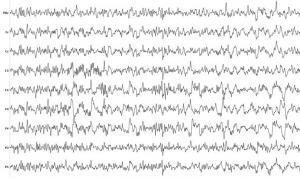 EEG (Elektroensefalografi) Nedir ve Nasıl Çalışır?
