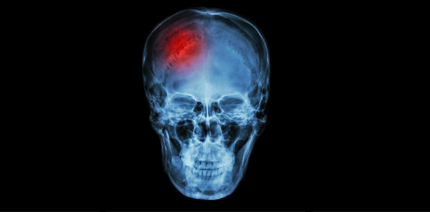 Travmatik Beyin Hasarı, Nedenleri ve Etkileri