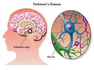 Parkinson Hastalığını Tespit Etmenin Yeni Yolu