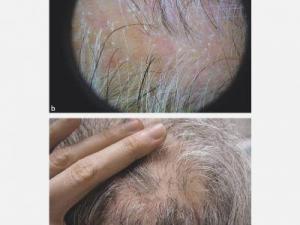 Sikatrisyel Alopesi Nedir?