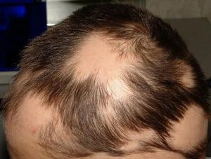 Sikatrisyel Alopesi Nedir?