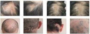 Sikatrisyel Alopesi Nedir?
