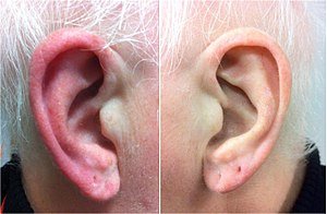 Kulak Yanması ve Kırmızı Kulak Sendromu Nedir?