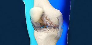 Diz Kireçlenmesinin (Osteoartrit) Evreleri ve Tedavi Şekilleri