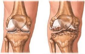 Diz Kireçlenmesinin (Osteoartrit) Evreleri ve Tedavi Şekilleri
