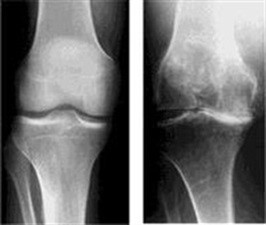 Diz Kireçlenmesinin (Osteoartrit) Evreleri ve Tedavi Şekilleri
