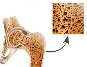 Osteoporozla Mücadelenin 17 Yolu