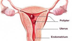 Polip Nedir?