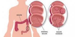Sigmoid Kolon Nedir?