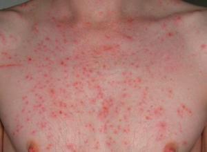 Dermatografi Nedir?