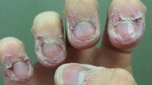 Dermatofaji nedir?