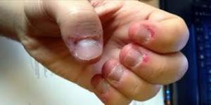 Dermatofaji nedir?