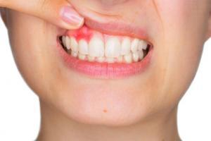 Dental İmplant Cerrahisinde Başarısızlık ve Komplikasyonlar