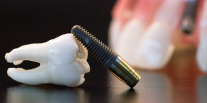 Dental İmplant Cerrahisinde Başarısızlık ve Komplikasyonlar