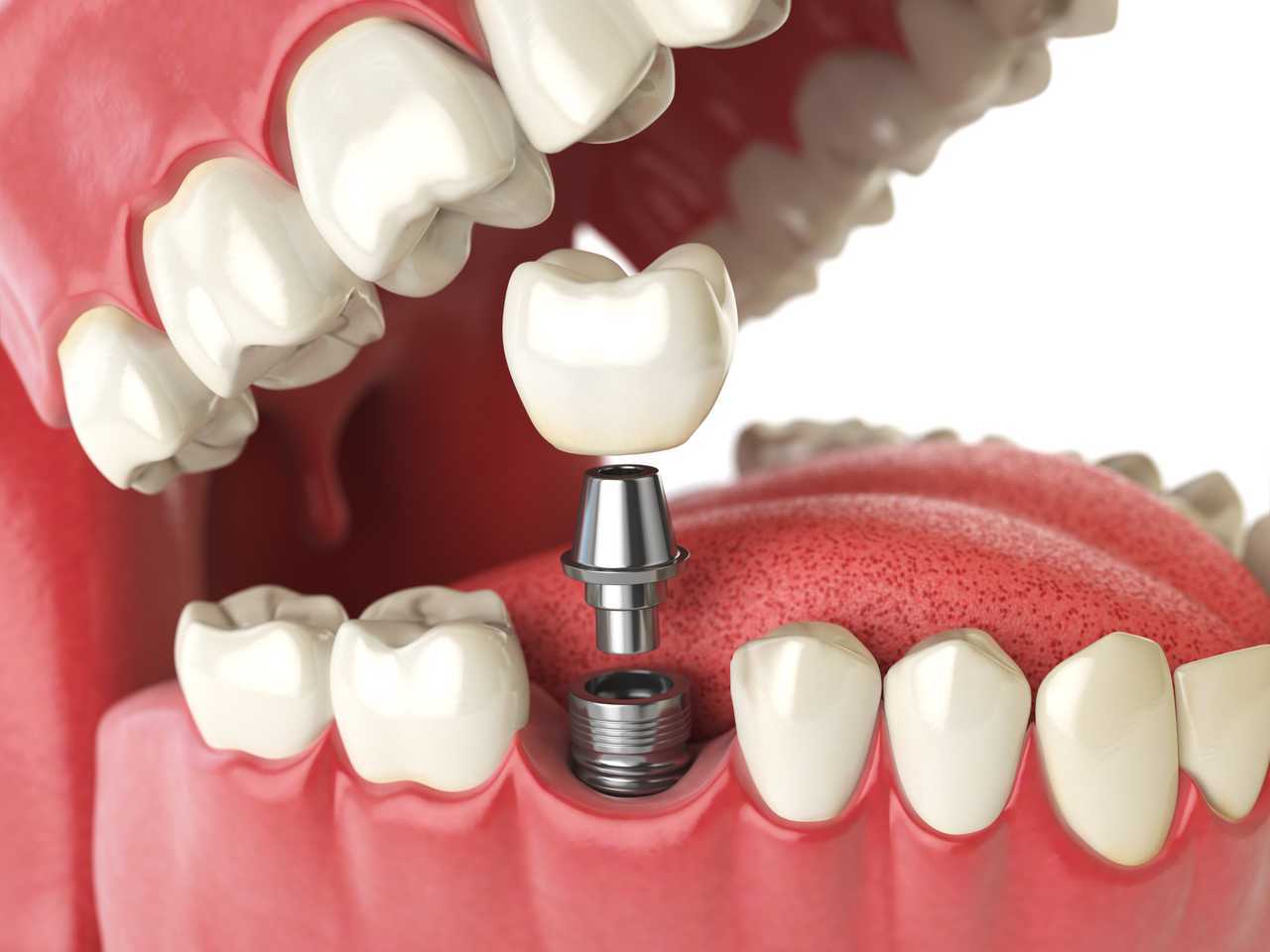 Dental İmplant Cerrahisinde Başarısızlık ve Komplikasyonlar