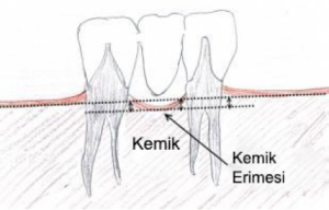 Dental İmplant Cerrahisinde Başarısızlık ve Komplikasyonlar