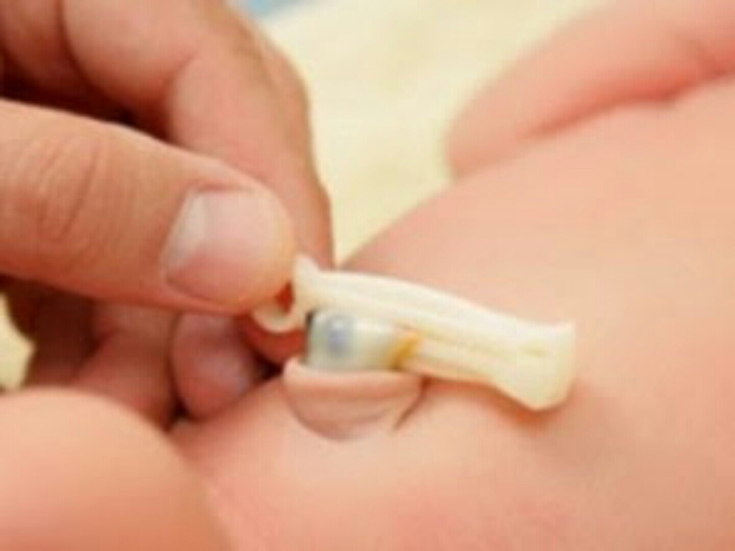 Bebeklerde Göbek Bağı İltihabı ve Tedavisi