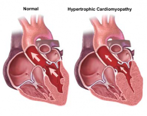 Hipertrofik Kardiyomiyopati Nedir?