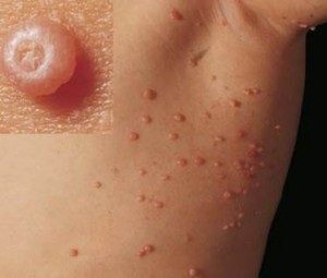 Molluskum Kontagiozum (Molluscum Contagiosum) Nedir?