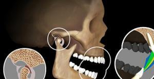 TME (Temporomandibular Eklem) Bozuklukları
