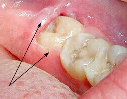 Perikoronit Nedir?