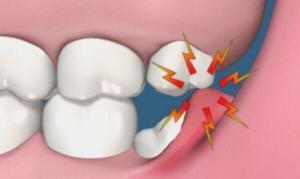 Perikoronit Nedir?