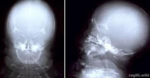 Akondrogenezis Nedir?