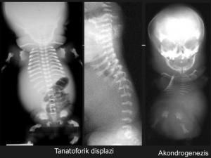 Akondrogenezis Nedir?
