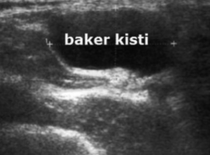 Baker Kistinin (Popliteal Kist) Belirtileri, Nedenleri ve Tedavisi