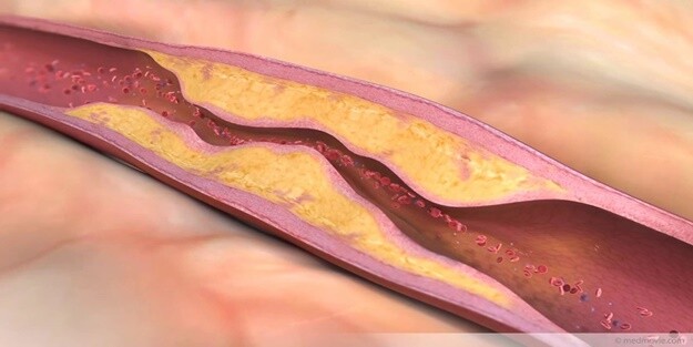 Tıkalı Arterler-Belirtileri, Nedenleri Diyet İpuçları ve Doğal Çözümler