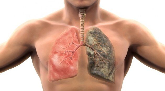 Sigara İçenle İçmeyenlerdeki Akciğer Kanseri Farklılıkları