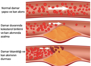 HDL ve LDL Kolesterol Arasındaki Fark Nedir?
